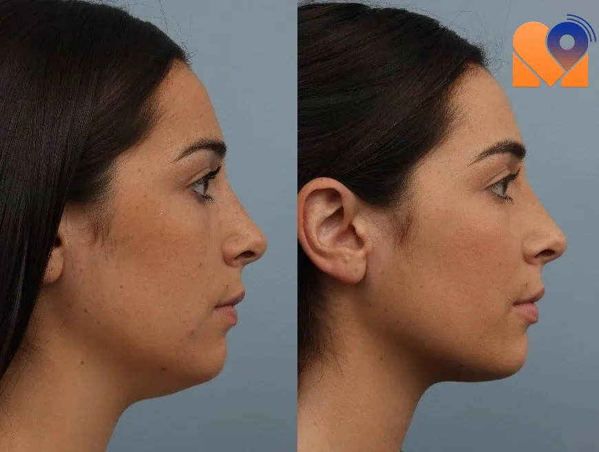 لیپوماتیک غبغب چیست؟