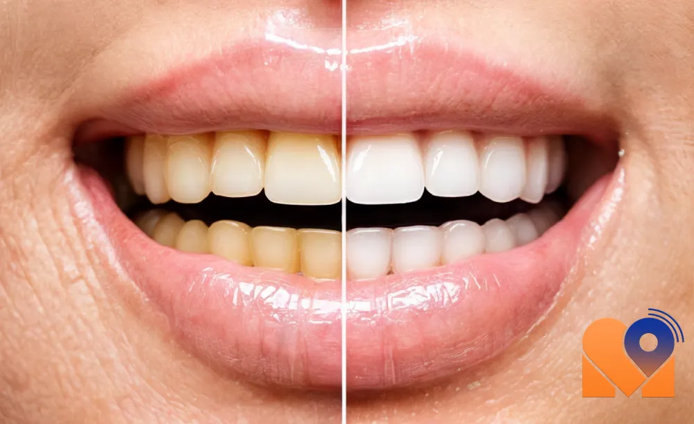 انواع روش های بلیچینگ دندان در تهران