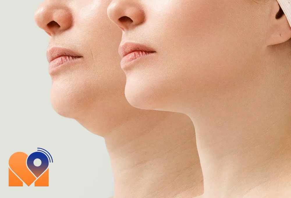 نوبت دهی اینترنتی بهترین دکتر ساکشن غبغب