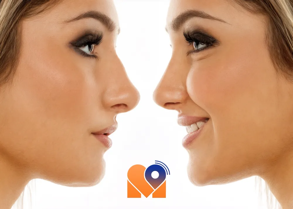جراحی قوز بینی