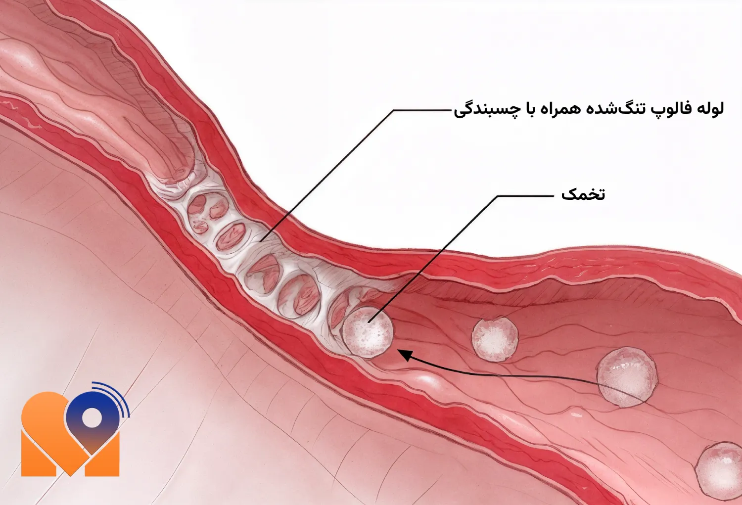 درمان چسبندگی لوله فالوپ
