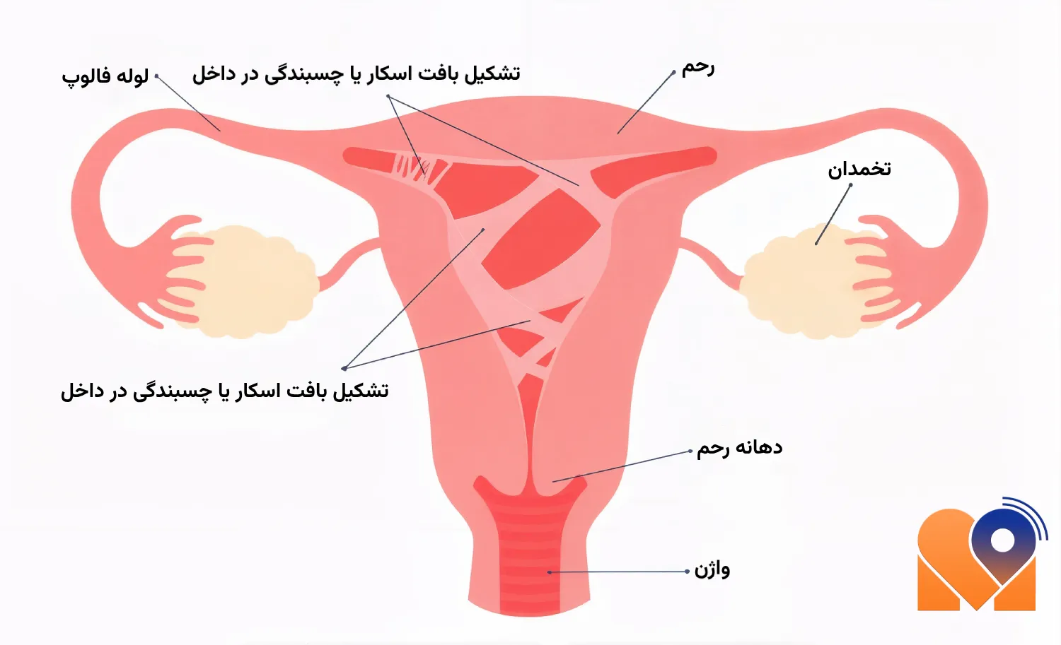 درمان چسبندگی رحم