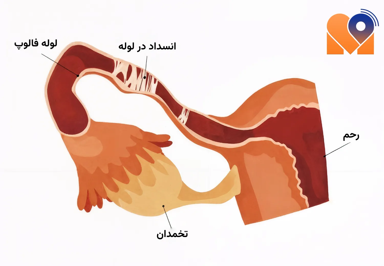 روش تشخیص چسبندگی لوله فالوپ