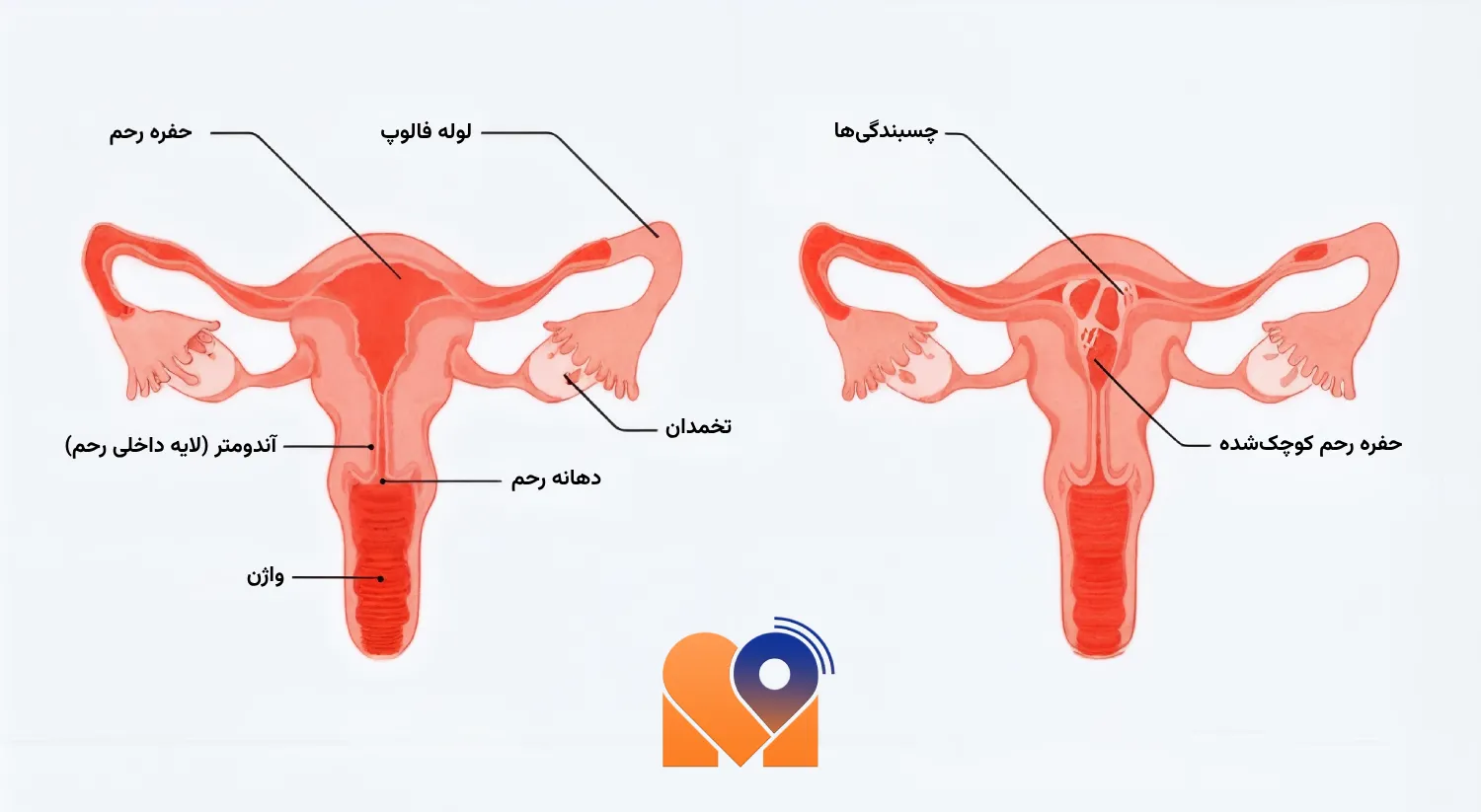 چسبندگی رحم
