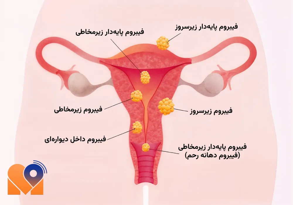 فیبروم رحم در بارداری