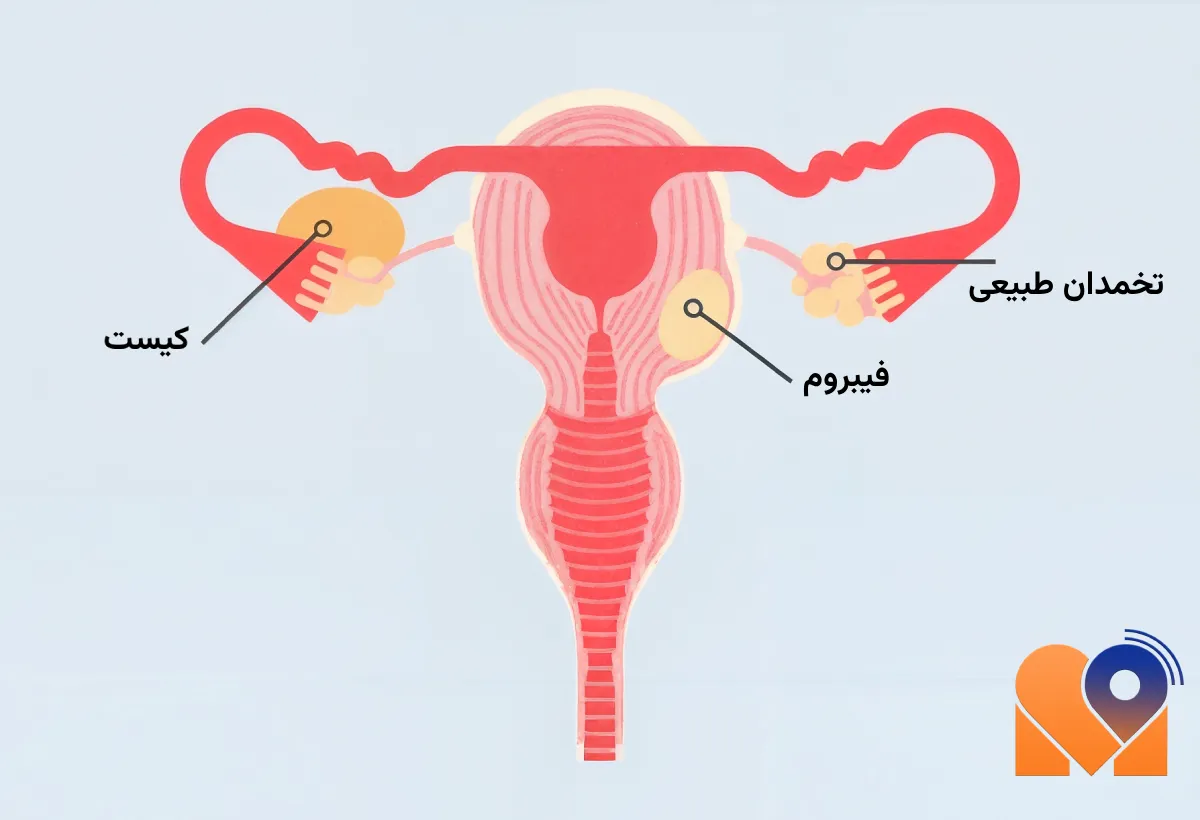 چه زمانی فیبروم رحم خطرناک میشود؟