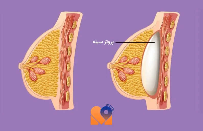  پروتز سینه