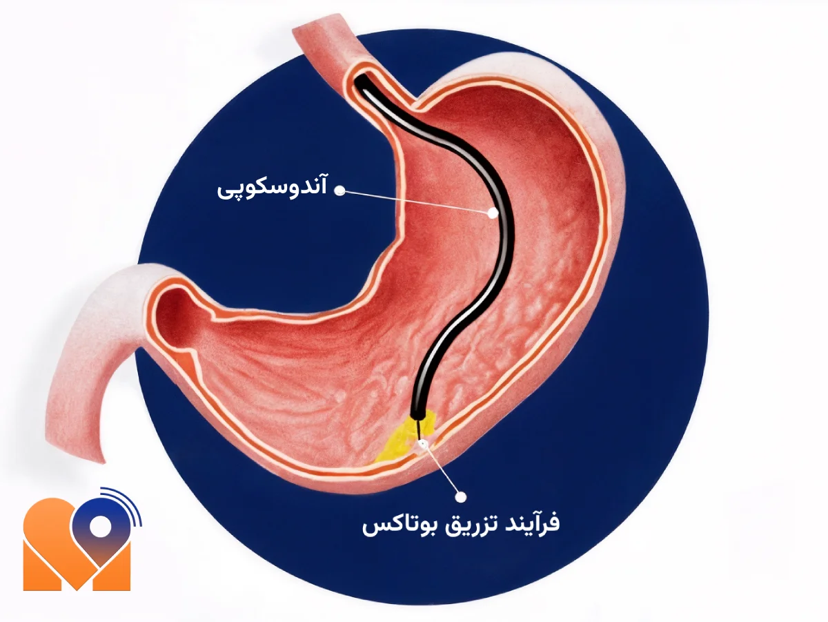 چگونه بهترین دکتر برای بوتاکس معده را پیدا کنیم؟