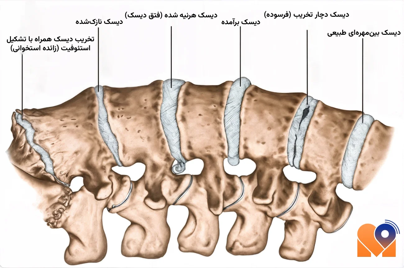 بیماری های ستون فقرات