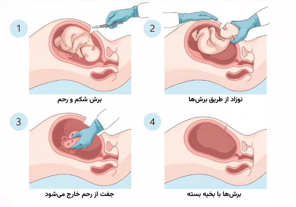 بهترین دکتر سزارین
