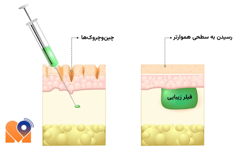 بهترین دکتر تزریق فیلر
