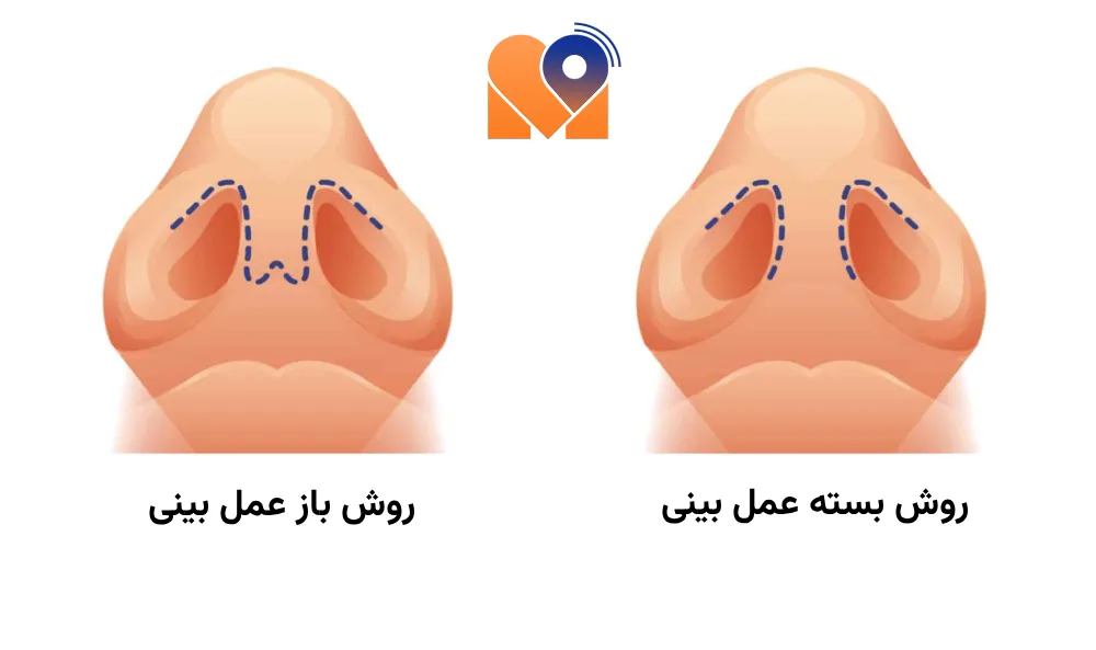 بهترین دکتر عمل بینی به روش بسته