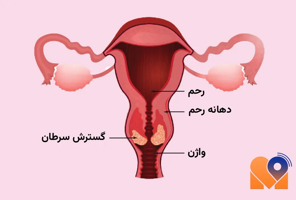 سرطان دهانه رحم