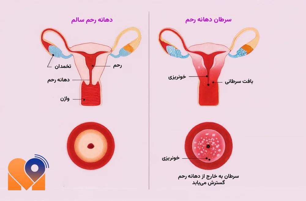 بهترین دکتر سرطان دهانه رحم