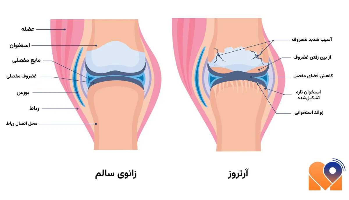 بهترین دکتر آرتروز