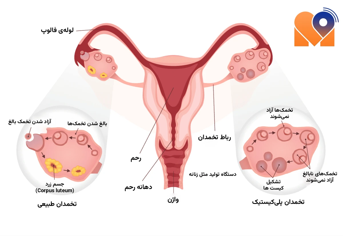 بهترین دکتر تنبلی تخمدان (پلی کیستیک)