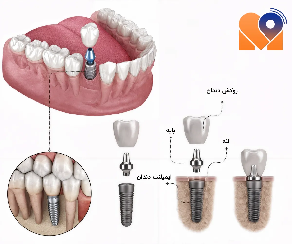 بهترین دکتر ایمپلنت دندان