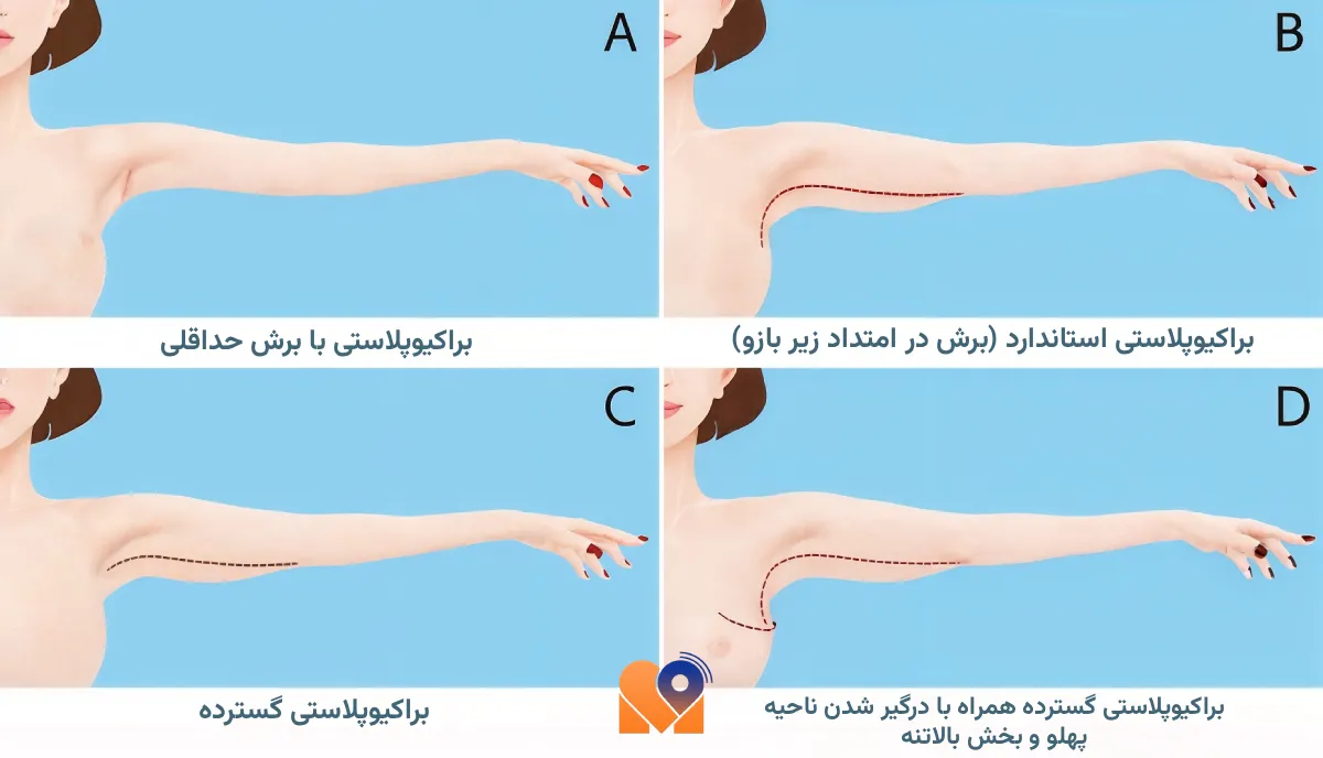 جراحی لیفت بازو