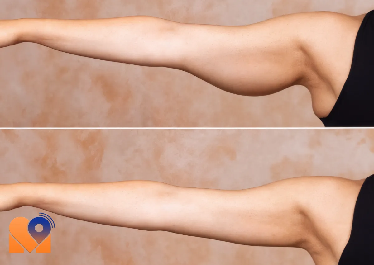 هزینه جراحی لیفت بازو