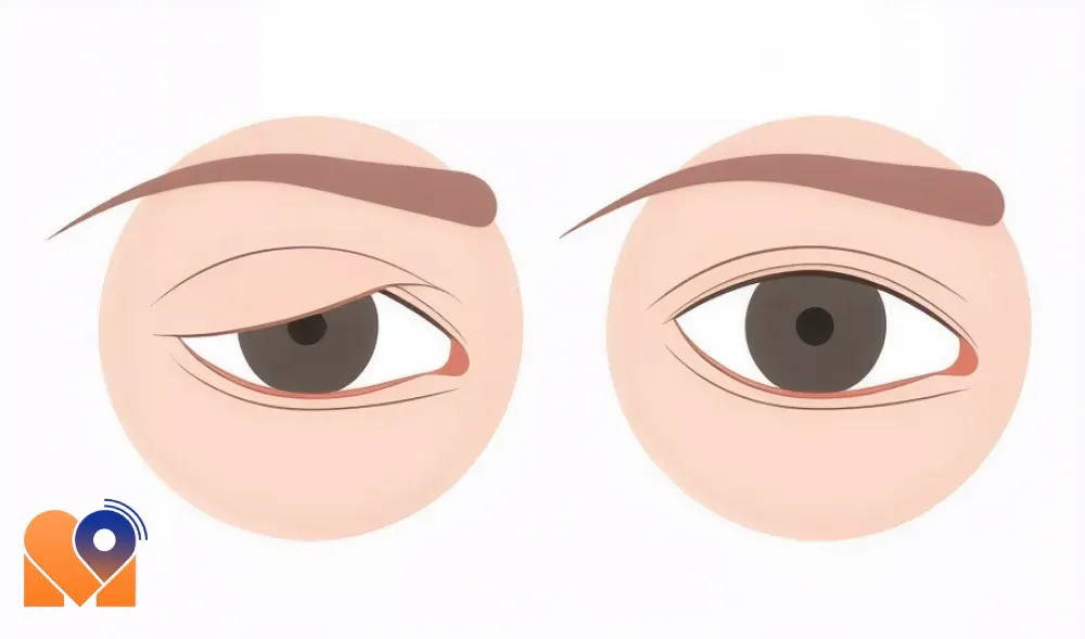 هزینه جراحی افتادگی پلک