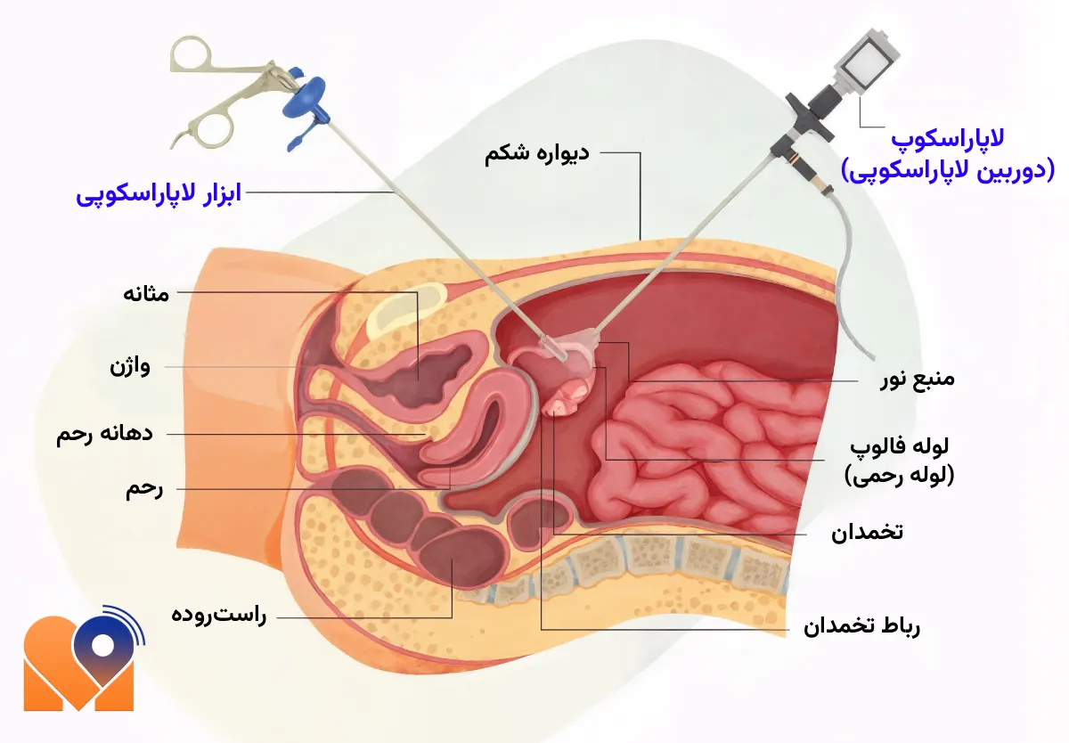 بهترین دکتر لاپاراسکوپی