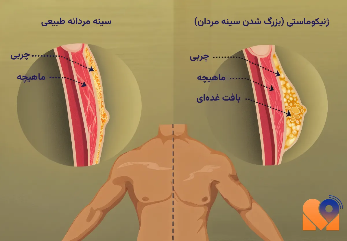 ژنیکوماستی