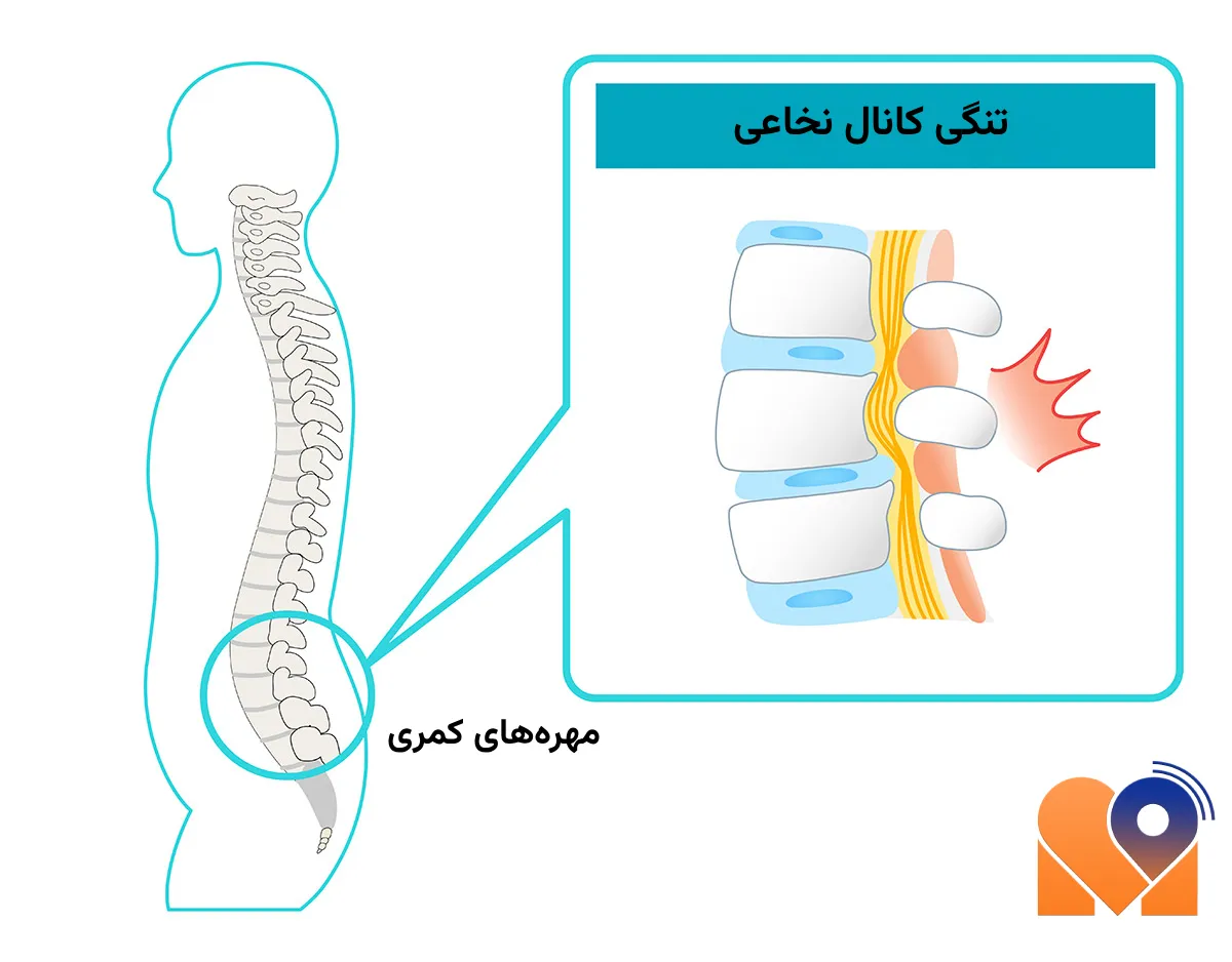 جراحی تنگی کانال نخاعی