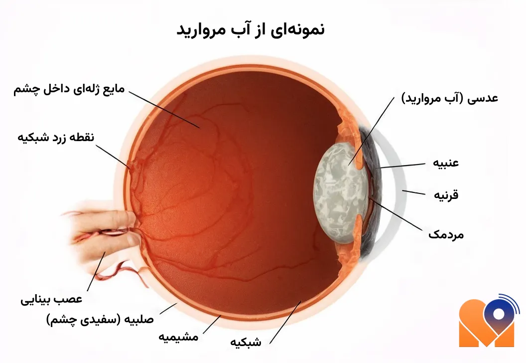 جراحی آب مروارید
