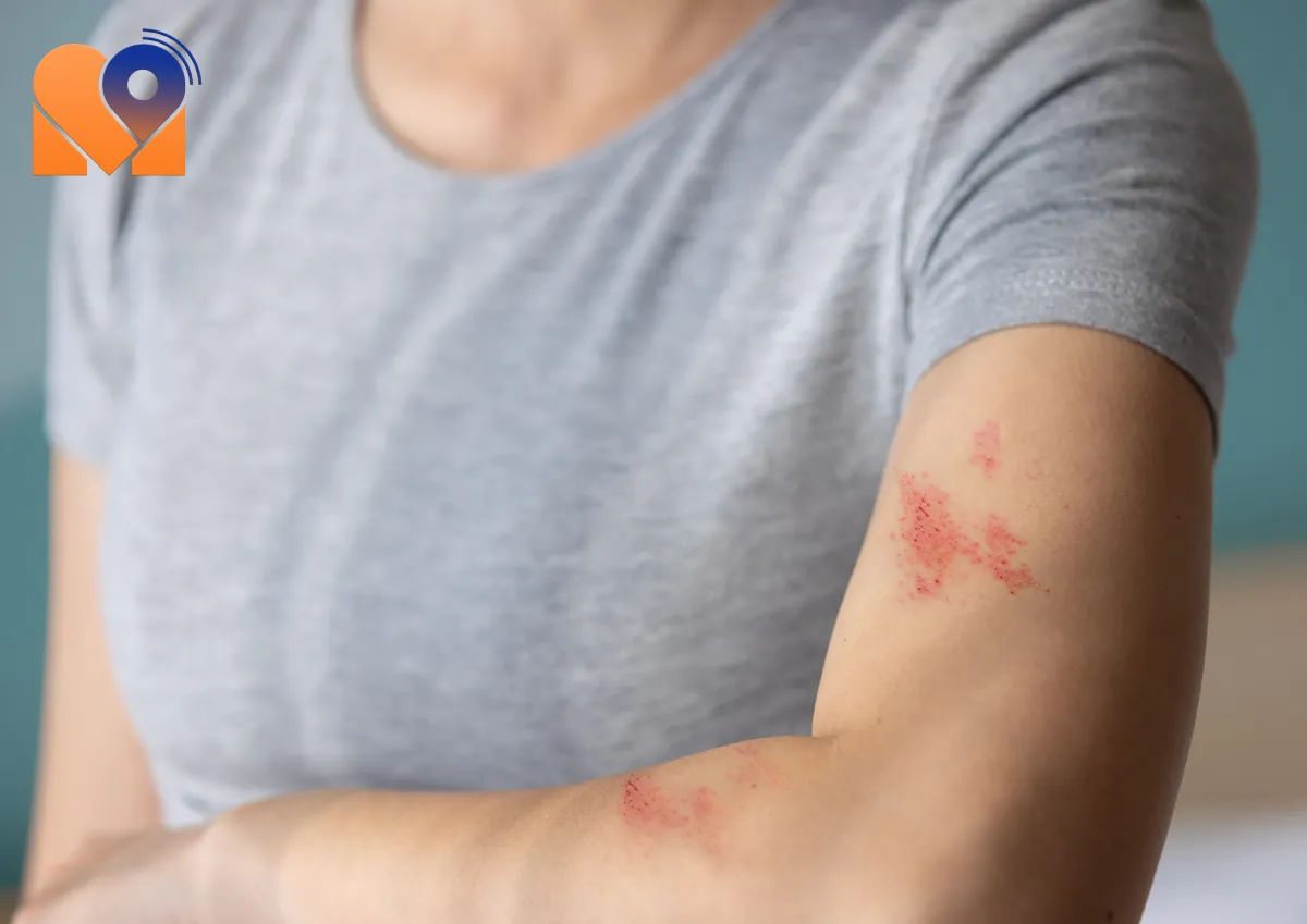 بهترین دکتر بیماری قارچ پوستی