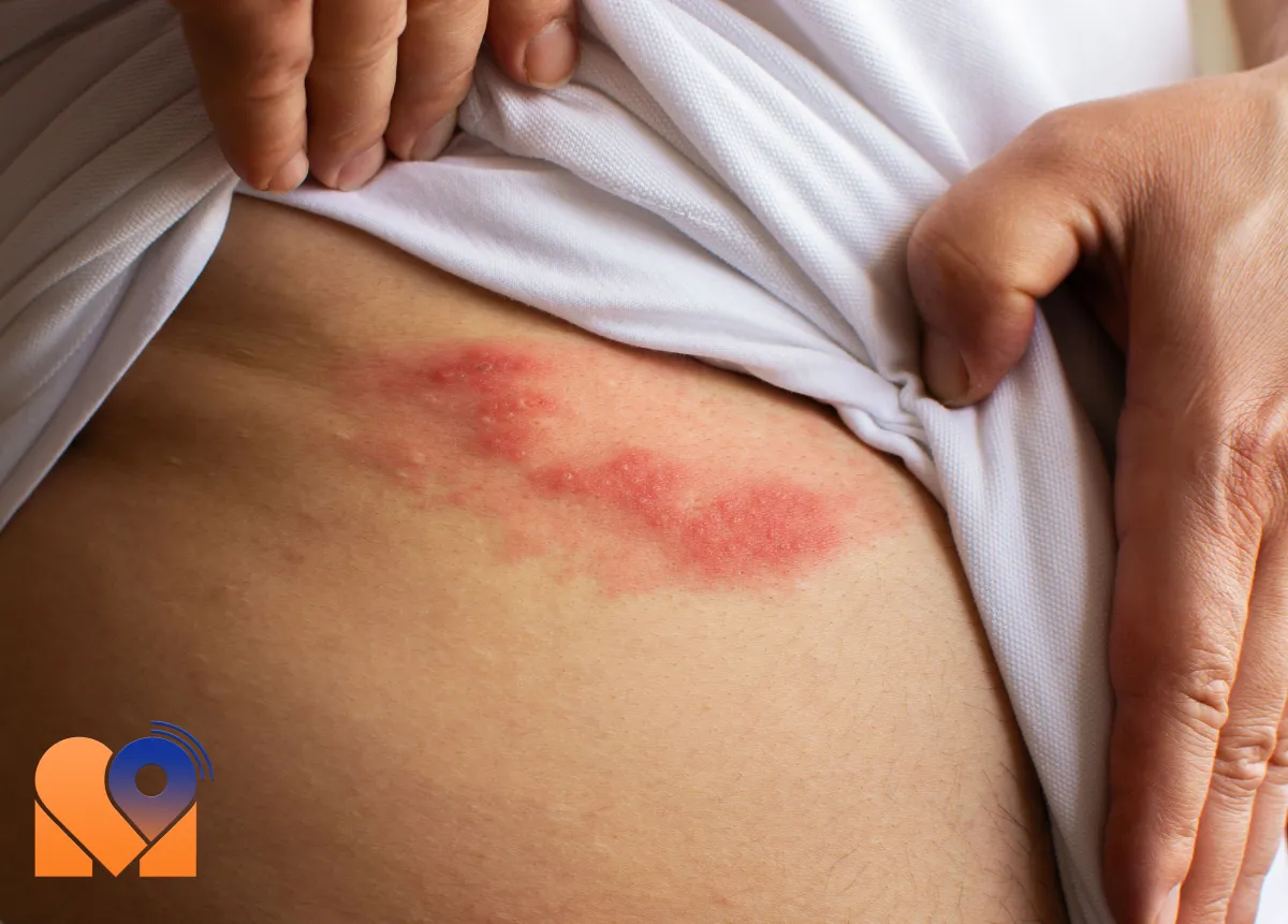 روشهای درمان قارچ پوستی