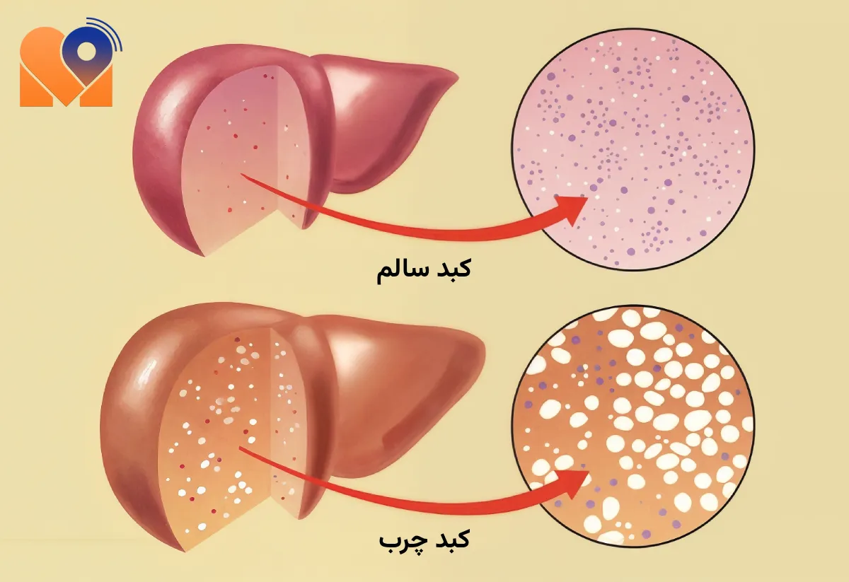 بهترین دکتر کبد چرب