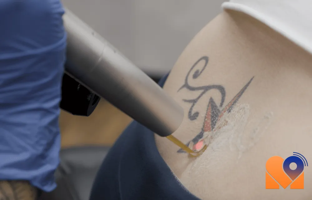 پاک کردن کامل تاتو