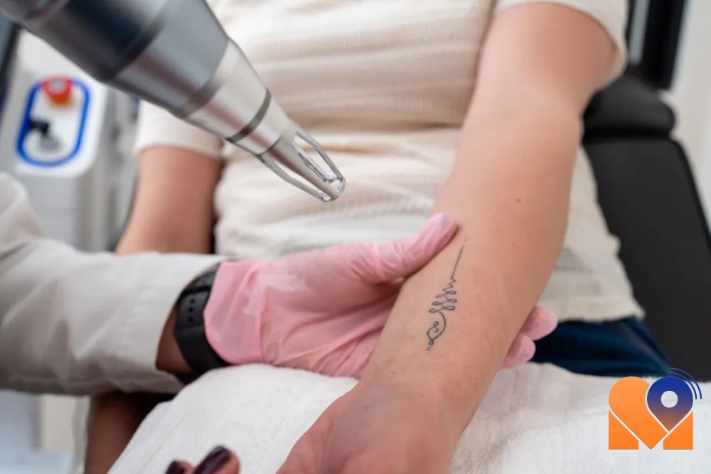 لیزر حذف تاتو