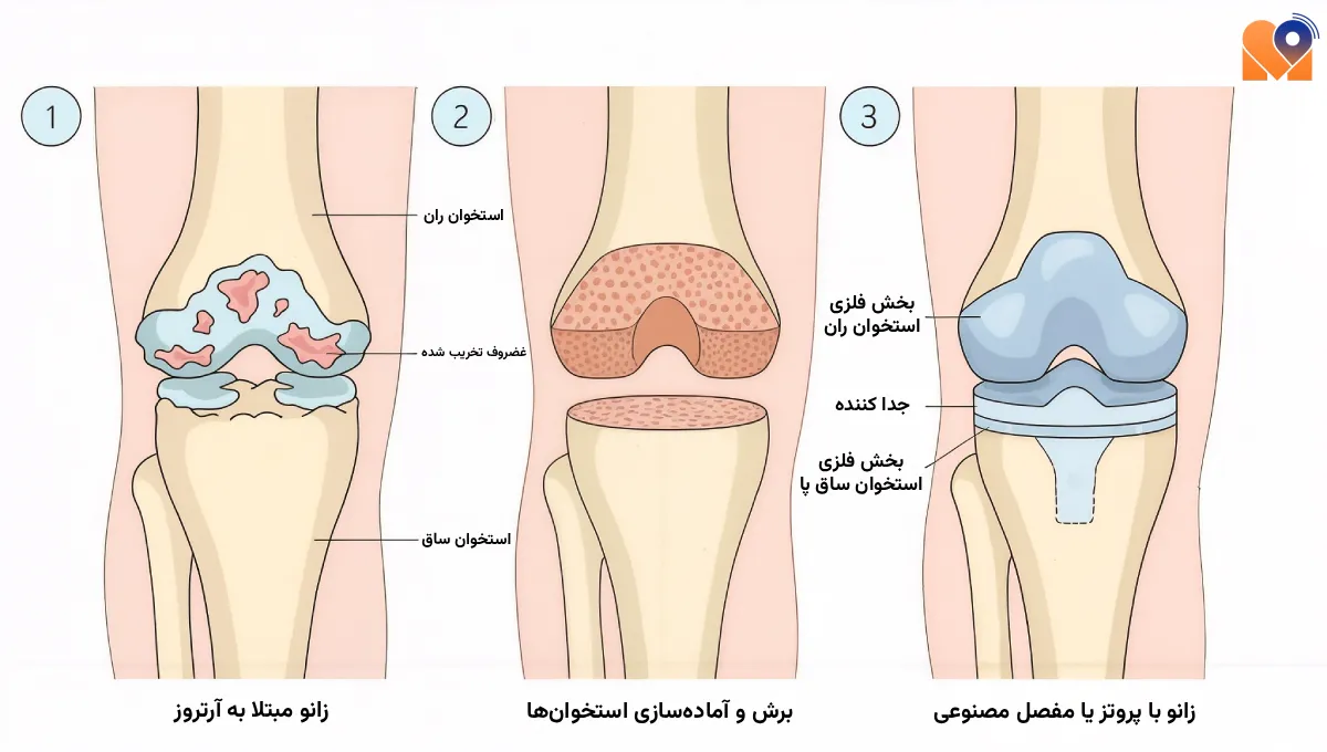 تعویض مفصل زانو
