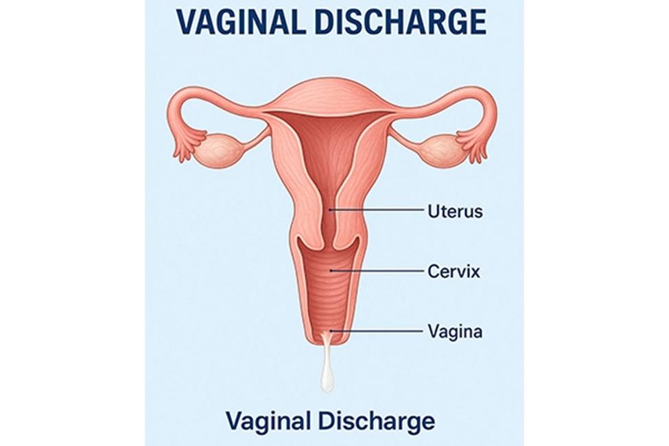 ترشحات واژن