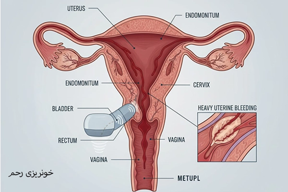 خونریزی رحم چیست؟