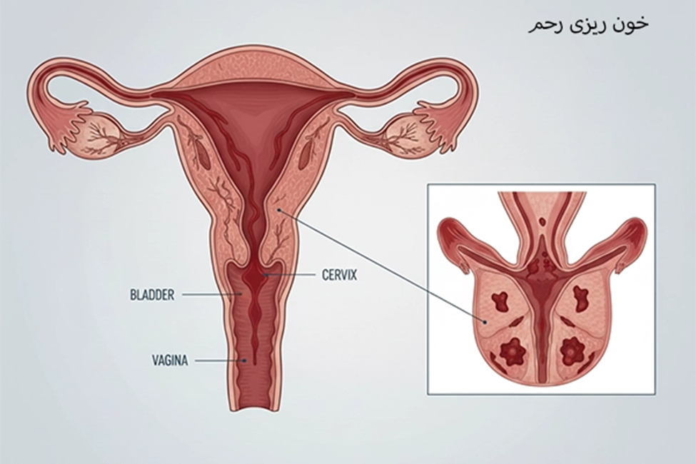 علائم و نشانه‌ های خونریزی رحم