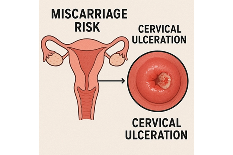 زخم دهانه رحم در دوران بارداری