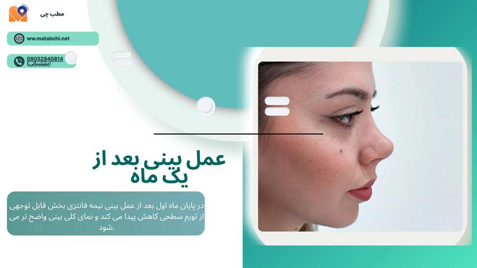 ماه اول  بعد از عمل بینی نیمه فانتزی