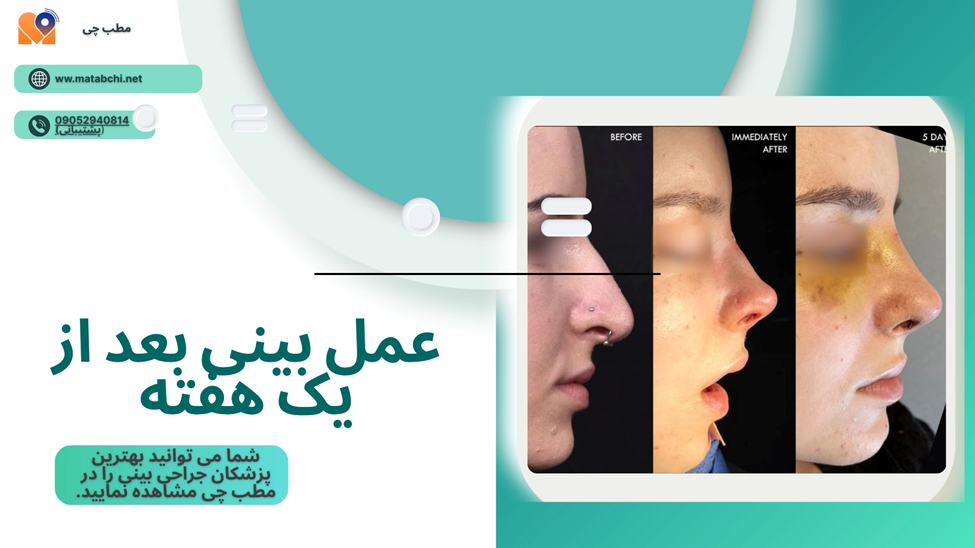 هفته اول بعد از عمل بینی نیمه فانتزی