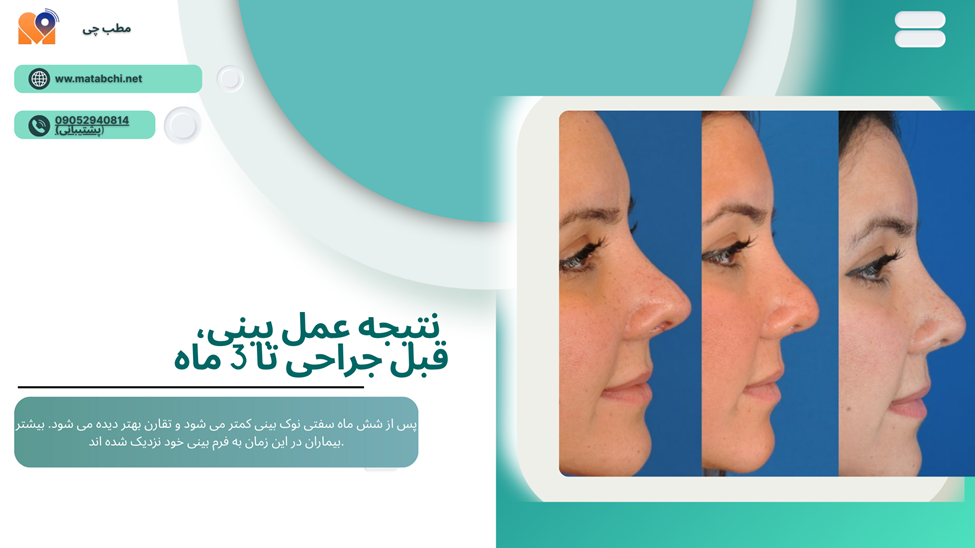 نتیجه بینی نیمه فانتزی بعد از سه ماه چه تغییری می کند