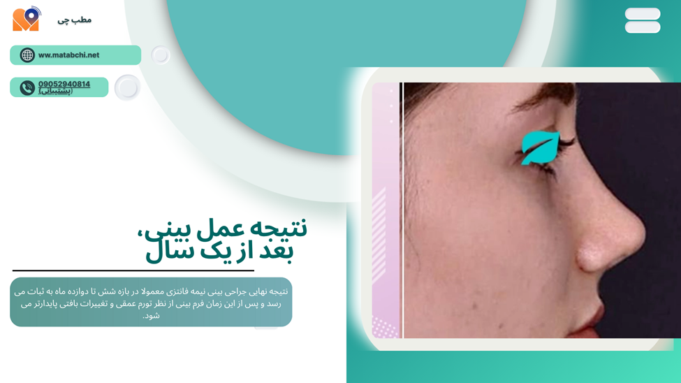 نتیجه نهایی عمل بینی نیمه فانتزی بعد از یک سال