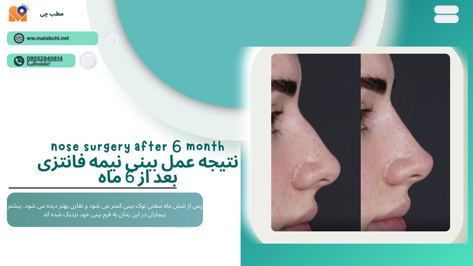 نتیجه عمل بینی نیمه فانتزی بعد از شش ماه