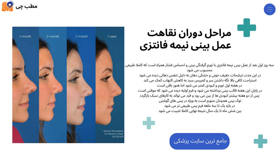 مراحل دوران نقاهت عمل بینی نیمه فانتزی