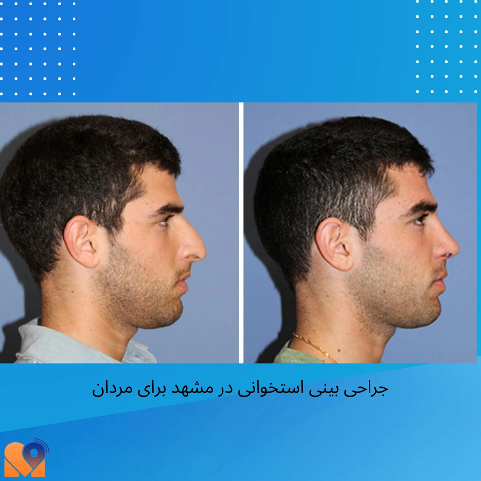 جراحی بینی استخوانی در مشهد برای مردان