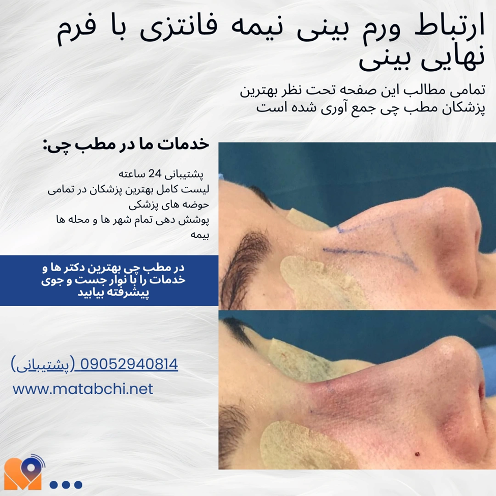 ارتباط ورم بینی نیمه فانتزی با فرم نهایی بینی