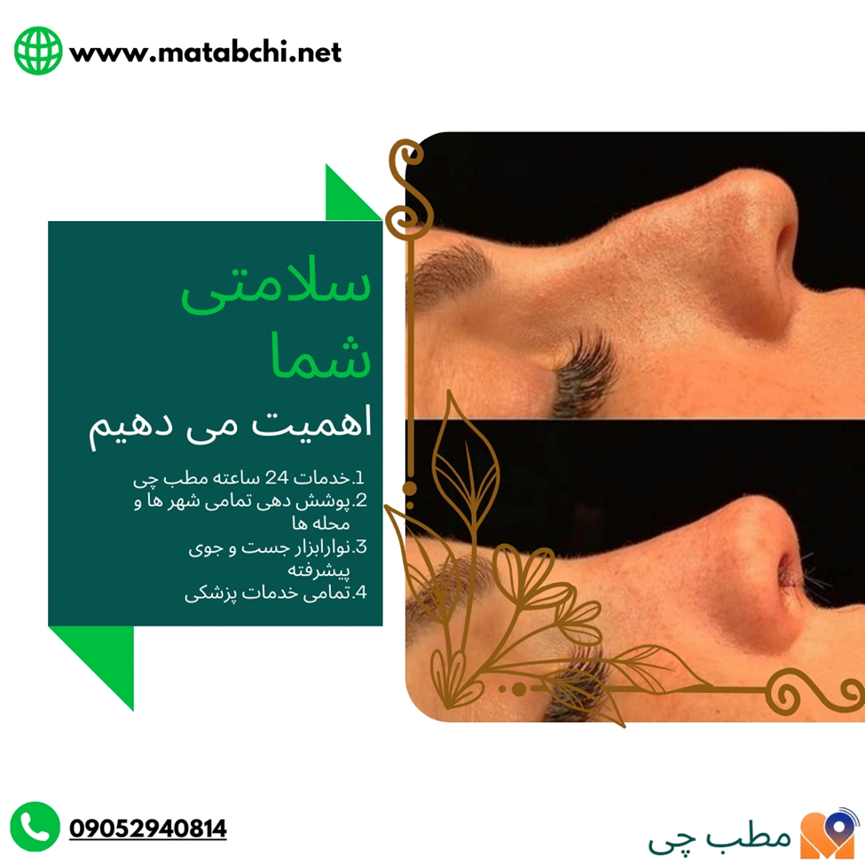 تصاویر قبل و بعد نمونه عمل بینی در شیراز