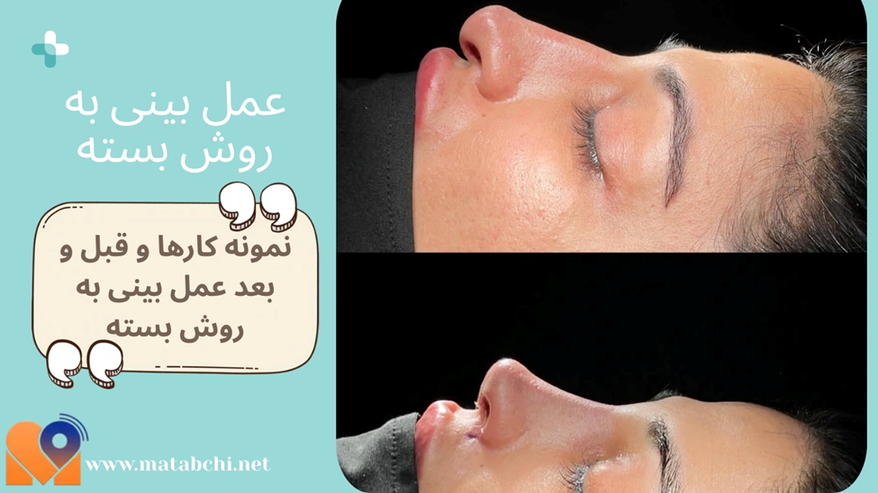 نمونه کارها و قبل و بعد عمل بینی به روش بسته