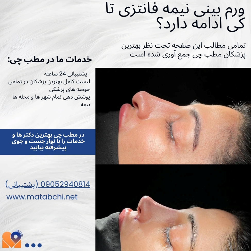 ارتباط سفتی نوک بینی با روند نقاهت و ورم آن