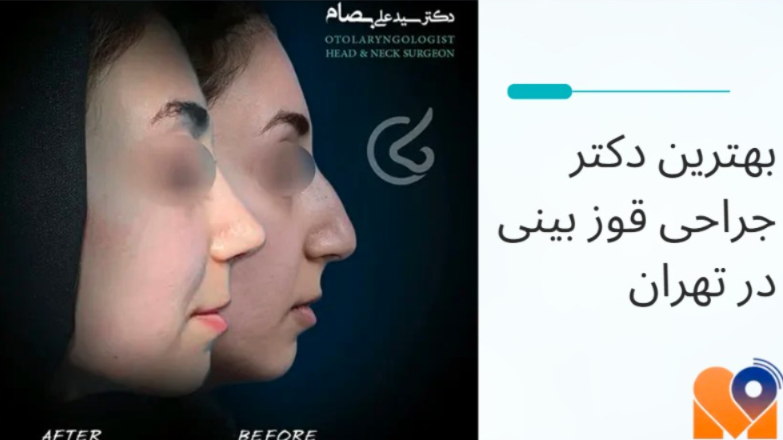 نمونه کار دکتر علی بصام برای جراحی قوز بینی